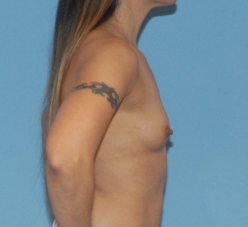 Breast Augmentation Before & After