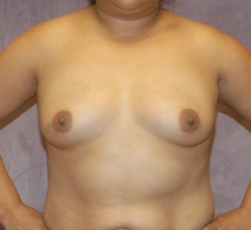 Breast Augmentation Before & After