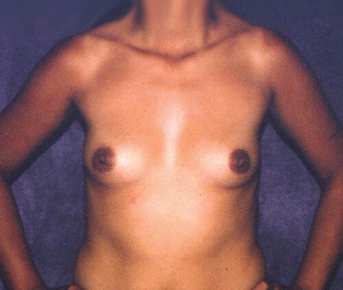 Breast Augmentation Before & After