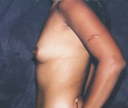 Breast Augmentation Before & After