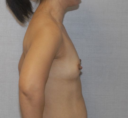Breast Augmentation Before & After