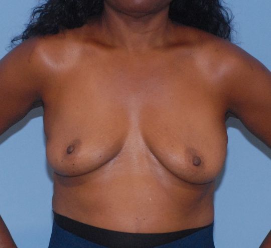 Breast Augmentation Before & After