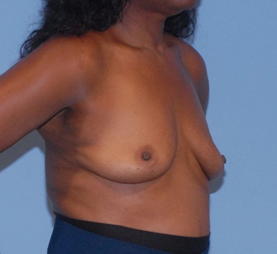 Breast Augmentation Before & After