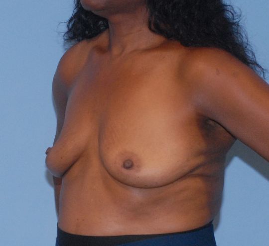 Breast Augmentation Before & After
