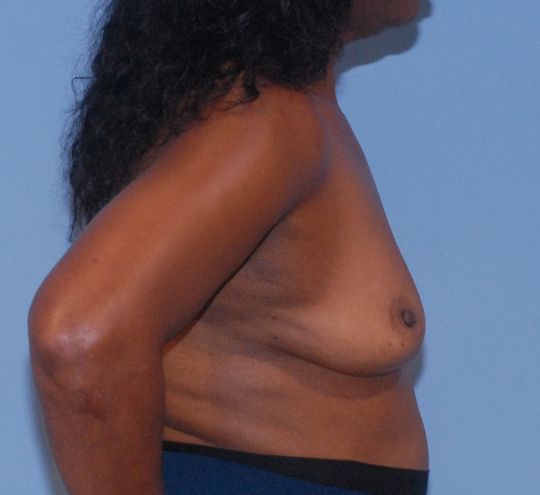 Breast Augmentation Before & After