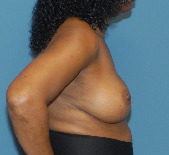 Breast Augmentation Before & After