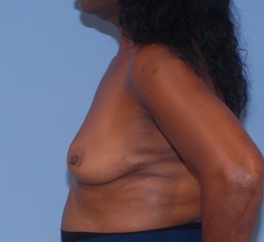 Breast Augmentation Before & After