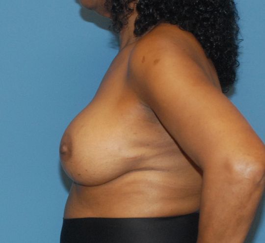 Breast Augmentation Before & After