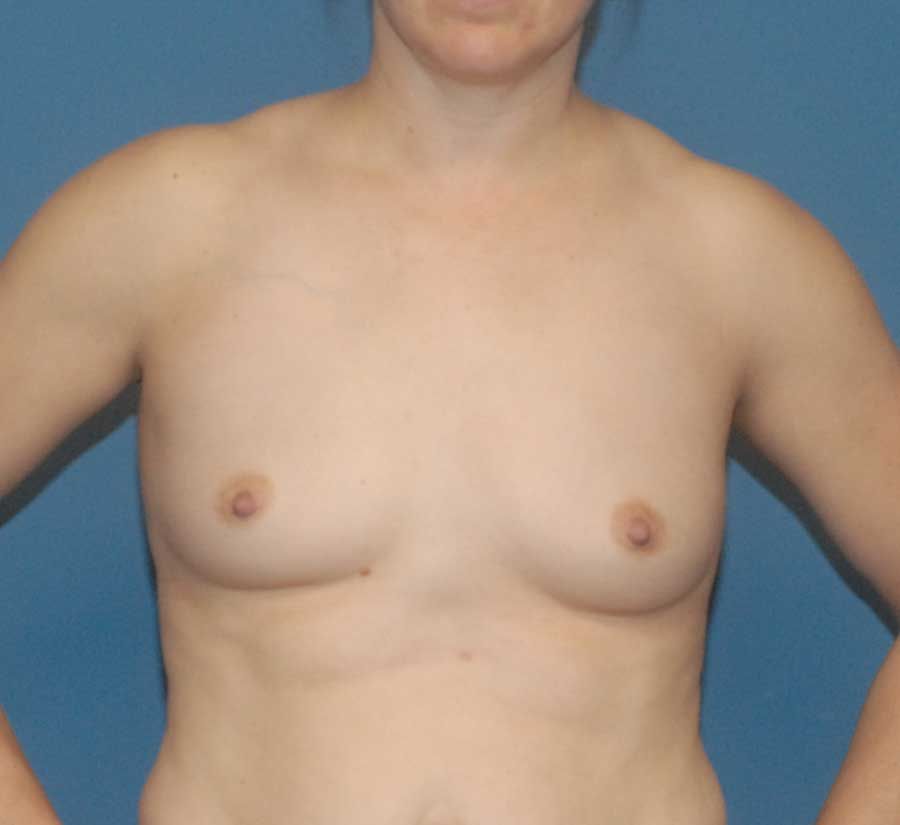 Breast Augmentation Before & After