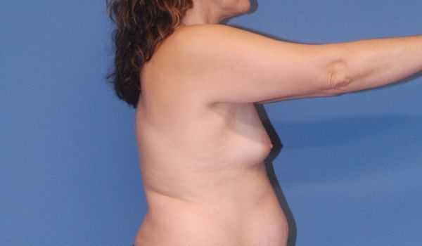Breast Augmentation Before & After