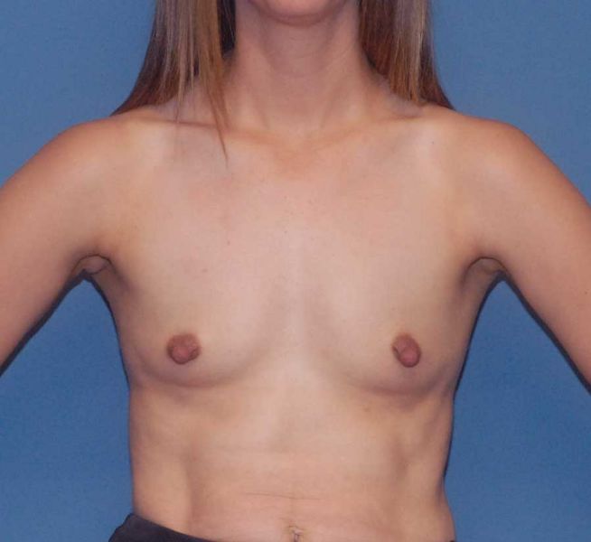 Breast Augmentation Before & After