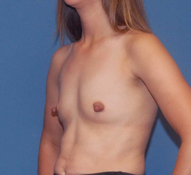 Breast Augmentation Before & After