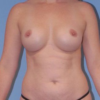 Breast Augmentation Before & After
