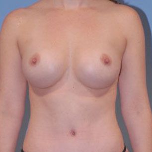 Breast Augmentation Before & After