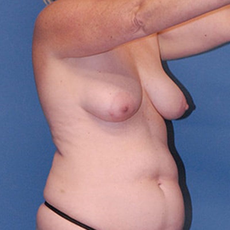 Fat Grafting To Breast Before & After