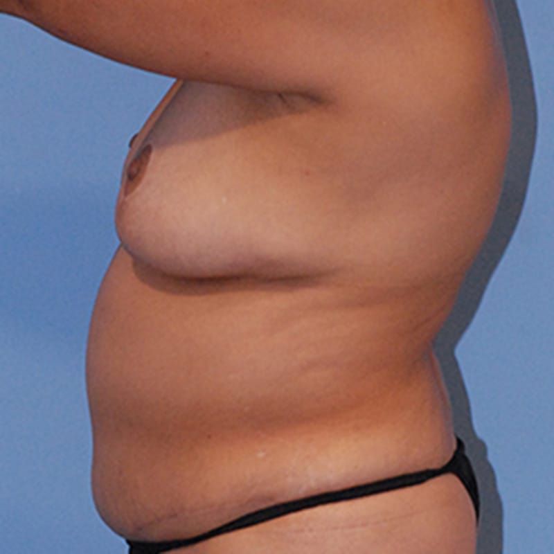 Fat Grafting To Breast Before & After