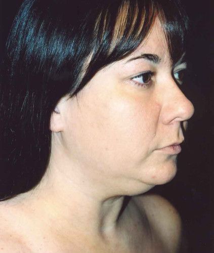 Liposuction Face Before & After