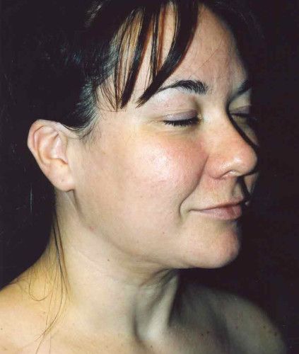 Liposuction Face Before & After