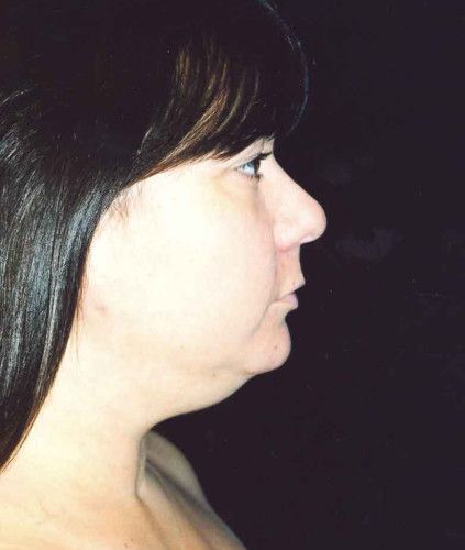 Liposuction Face Before & After