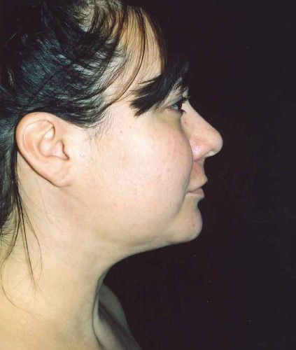 Liposuction Face Before & After