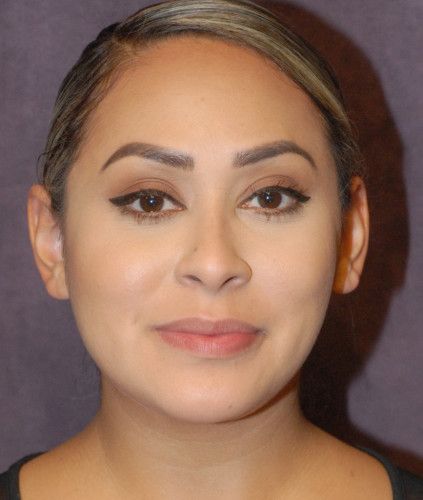 Liposuction Face Before & After