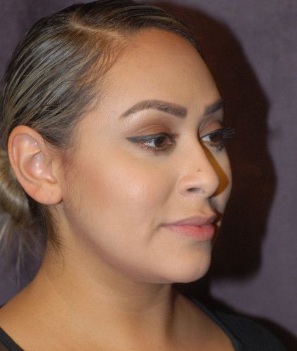 Liposuction Face Before & After