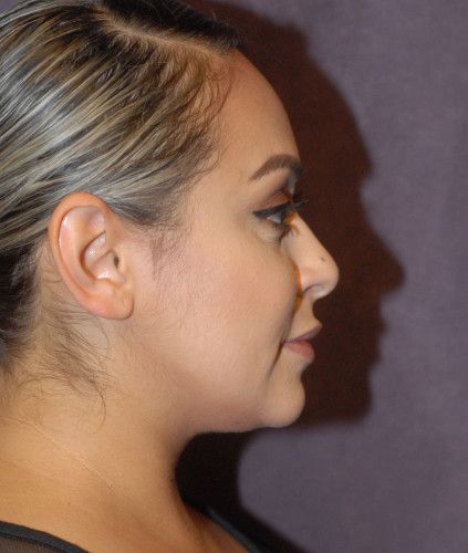 Liposuction Face Before & After