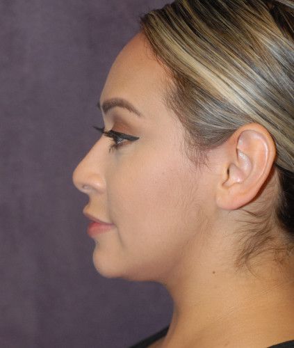 Liposuction Face Before & After