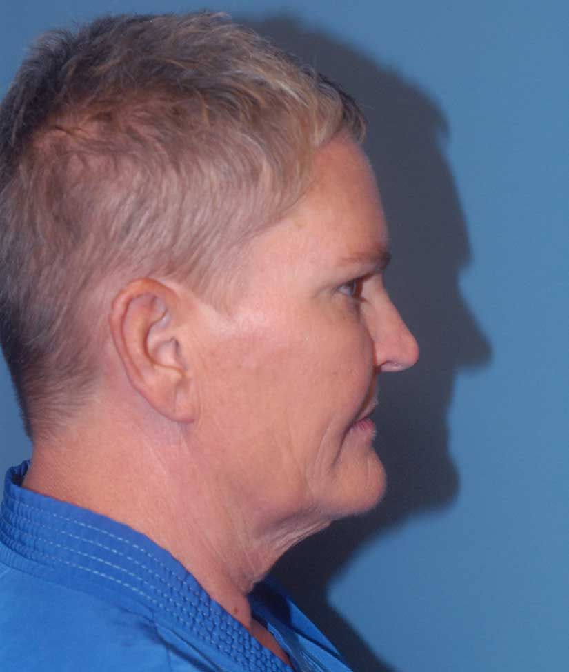 Liposuction Face Before & After