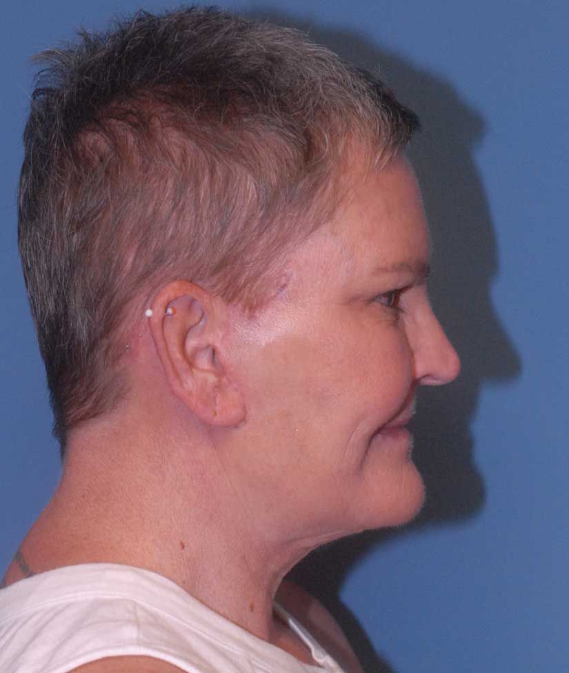 Liposuction Face Before & After