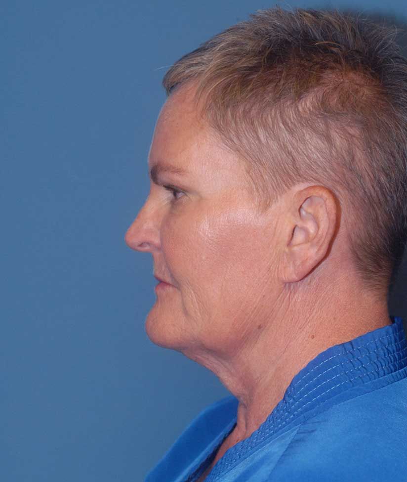 Liposuction Face Before & After