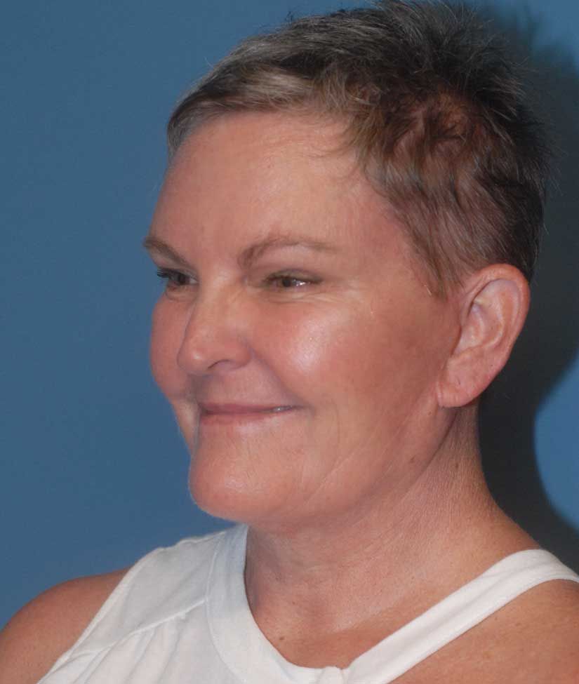 Liposuction Face Before & After