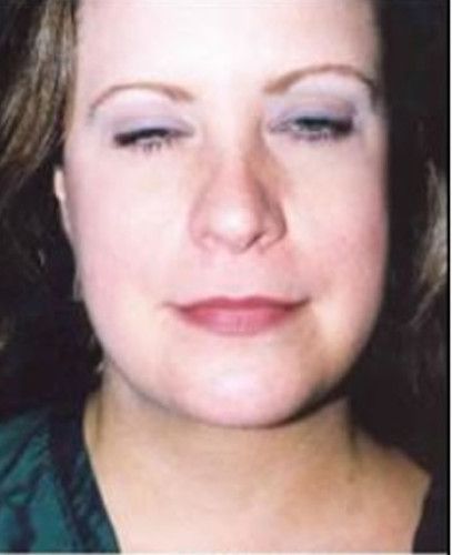 Liposuction Face Before & After