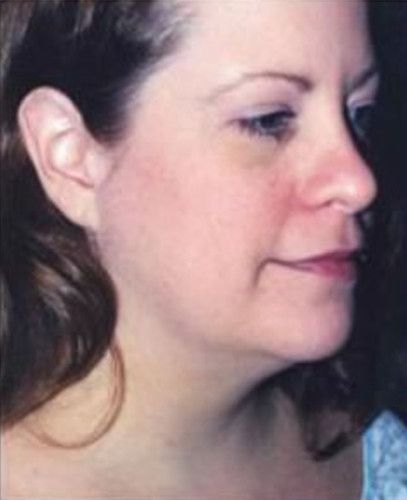 Liposuction Face Before & After