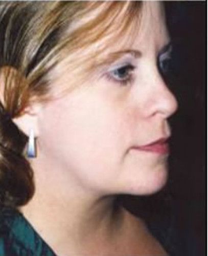 Liposuction Face Before & After