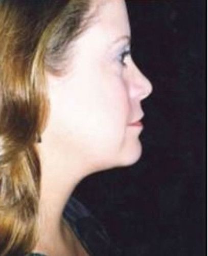 Liposuction Face Before & After