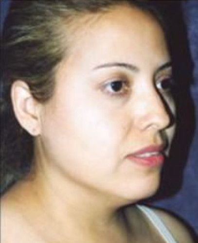 Liposuction Face Before & After