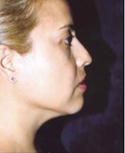 Liposuction Face Before & After
