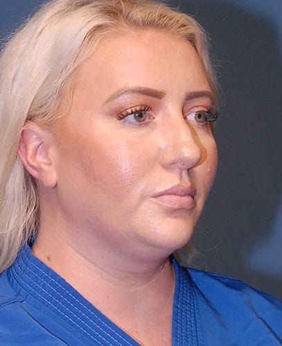 Liposuction Face Before & After