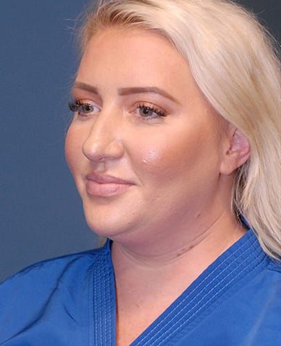 Liposuction Face Before & After