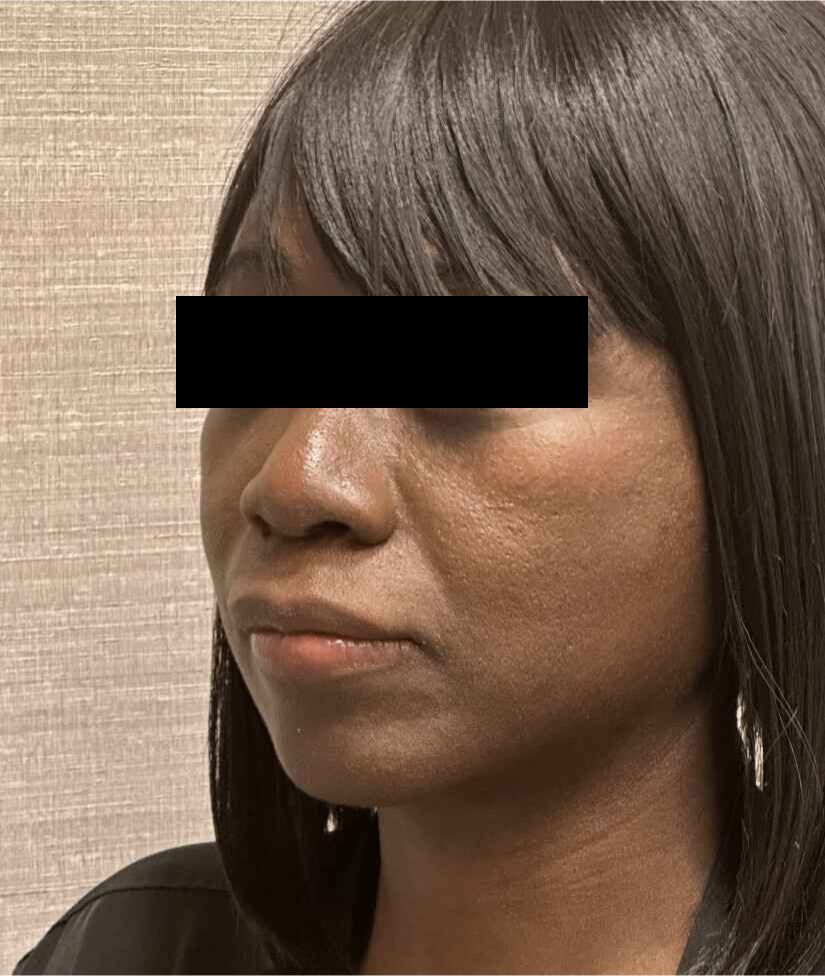 Liposuction Face Before & After