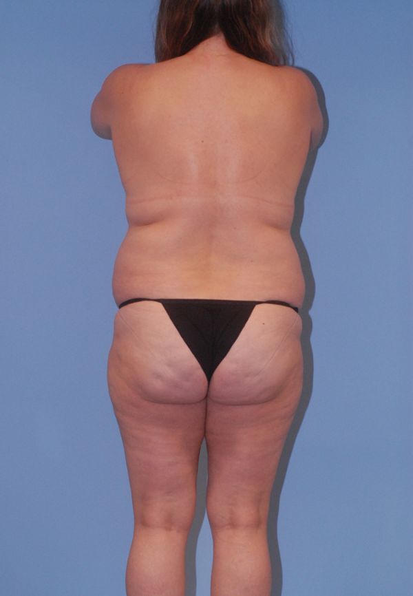 Fortes Figure Before & After