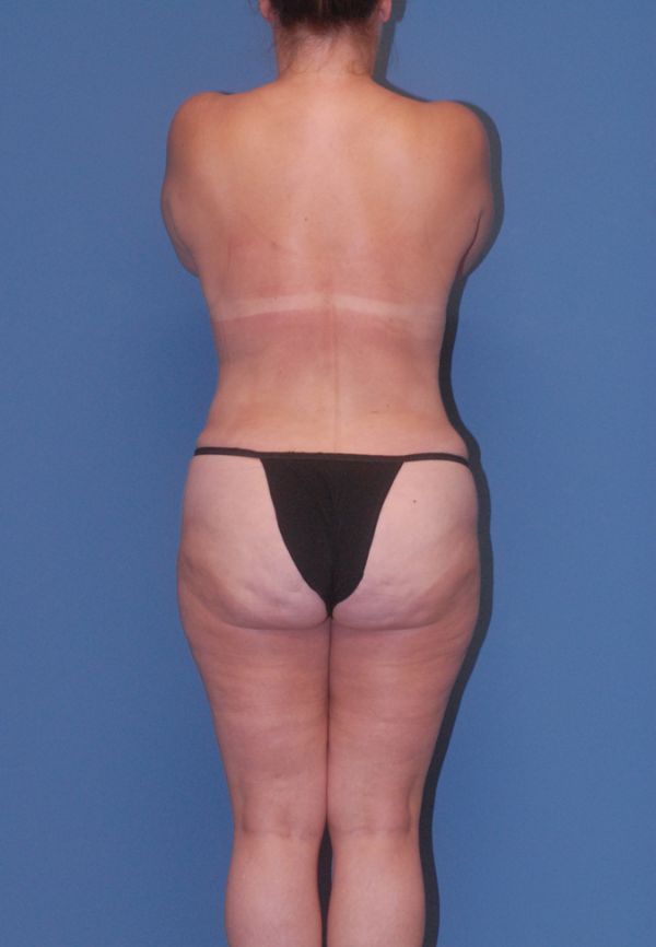 Fortes Figure Before & After