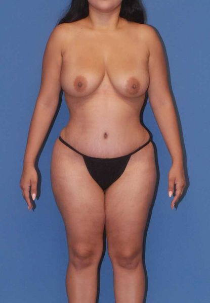 Fortes Figure Before & After