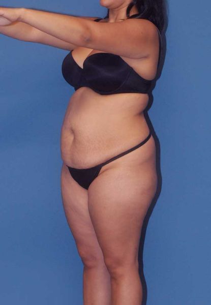 Fortes Figure Before & After