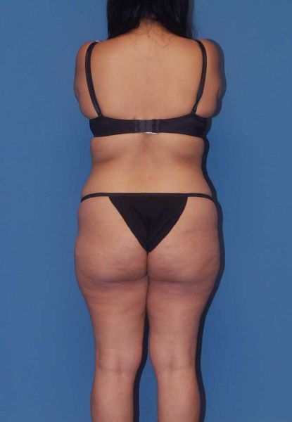 Fortes Figure Before & After