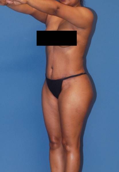 Fortes Figure Before & After