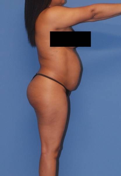 Fortes Figure Before & After