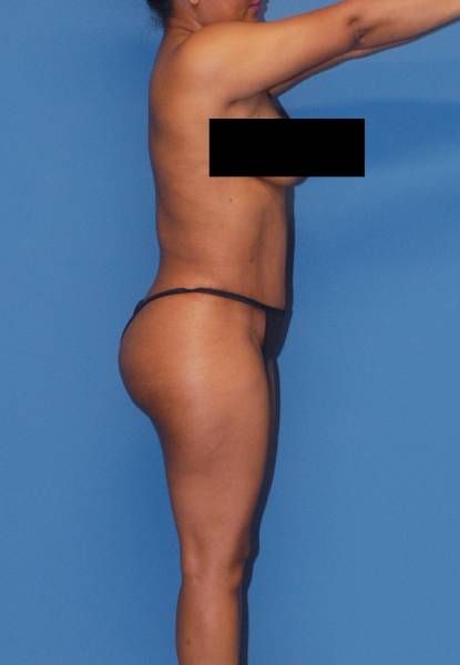 Fortes Figure Before & After