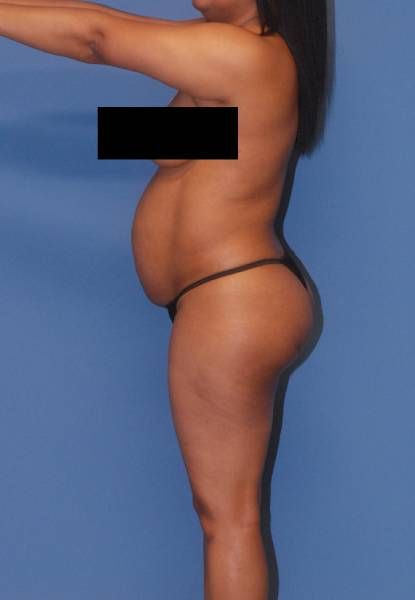 Fortes Figure Before & After